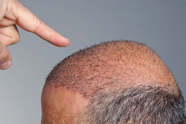 Why a Dubai Hair Transplant May be Right for You